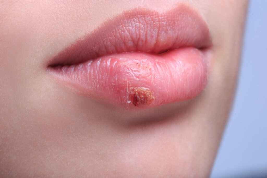 Herpes Labial