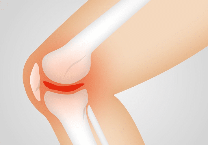 arthrose articulation genou